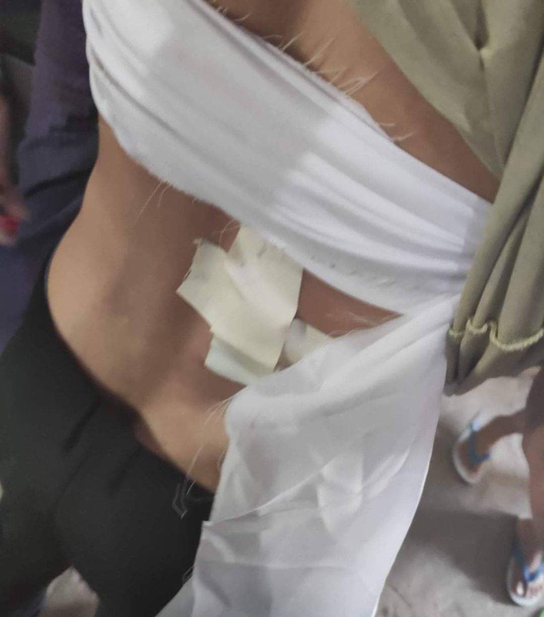 YyKana1's tweet photo. tw // blood
Junta terrorists recklessly opened gunfires near 54x111 st, Mandalay and injured a passerby carrying rice bag jn the back and arm. Other casualties are also reported.
#UnfetteredAccessForAids
#June22Coup 
#WhatsHappeningInMyanmar https://t.co/VJusV5haID https://t.co/nzmvJV0j7y