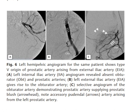 eFirst #AJIR Prostatic Artery Embolization for Benign Prostatic Hyperplasia: Anatomical Aspects and Radiation Considerations from a Case Series of 210 Patients Abstract: thieme-connect.com/products/ejour… Full text HTML: thieme-connect.com/products/ejour… Full text PDF: thieme-connect.com/products/ejour…