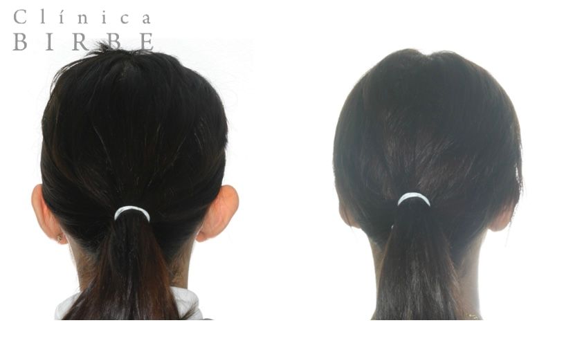 OTOPLASTIA  Hay diversas indicaciones para modificar la forma de las orejas. Lóbulos rasgados, orejas grandes que se pueden empequeñecer, pero la más típica es la que trata las llamadas “orejas en soplillo”. #rinoplastia #clinicabirbe #maxillofacial #otoplastia #otoplasty