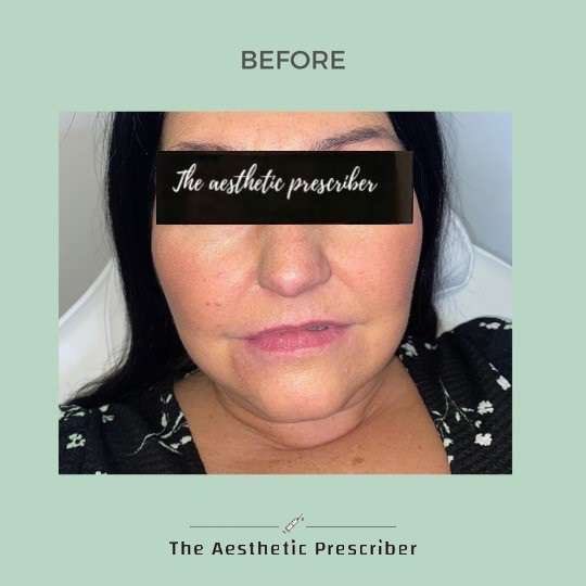 aestheticpresc's tweet photo. Dermal Fillers contain hyaluronic acid and collagen. They are both natural substances that are found in the body. They keep your skin looking full of volume, provide definition and gives it a plump youthful look. #aesthetic #dermalfiller #fillers #aesthetics #aestheticprescriber https://t.co/OoObO5s84o