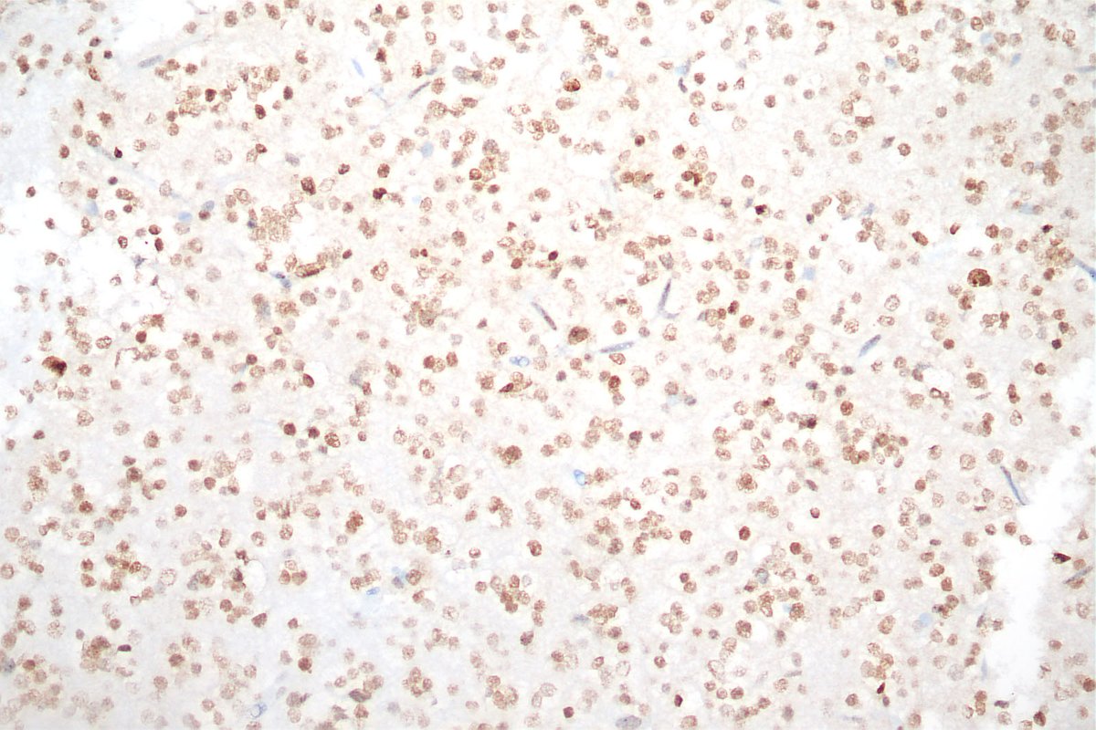 From the friday fellows conference - a true "mixed glioma"! The same block had both astrocytic (left) and oligodendroglial (right) regions, with ATRX loss in the atrocytic resions and retained expression in the oligodendroglial ones (lower images). #astrocytoma #oligodendroglioma