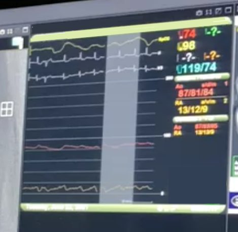 HRPCI 70 y/o patient.  Severe calcified LAD disease with CTO of RCA.  Despite normal EF, note the hemodynamics during PCI.  MAP stayed above 80 with ECP despite loss of pulsatility. Image guided, IVL, and guideliner assisted PCI. Closed with 8F angioseal. #ECP #smallboreMCS