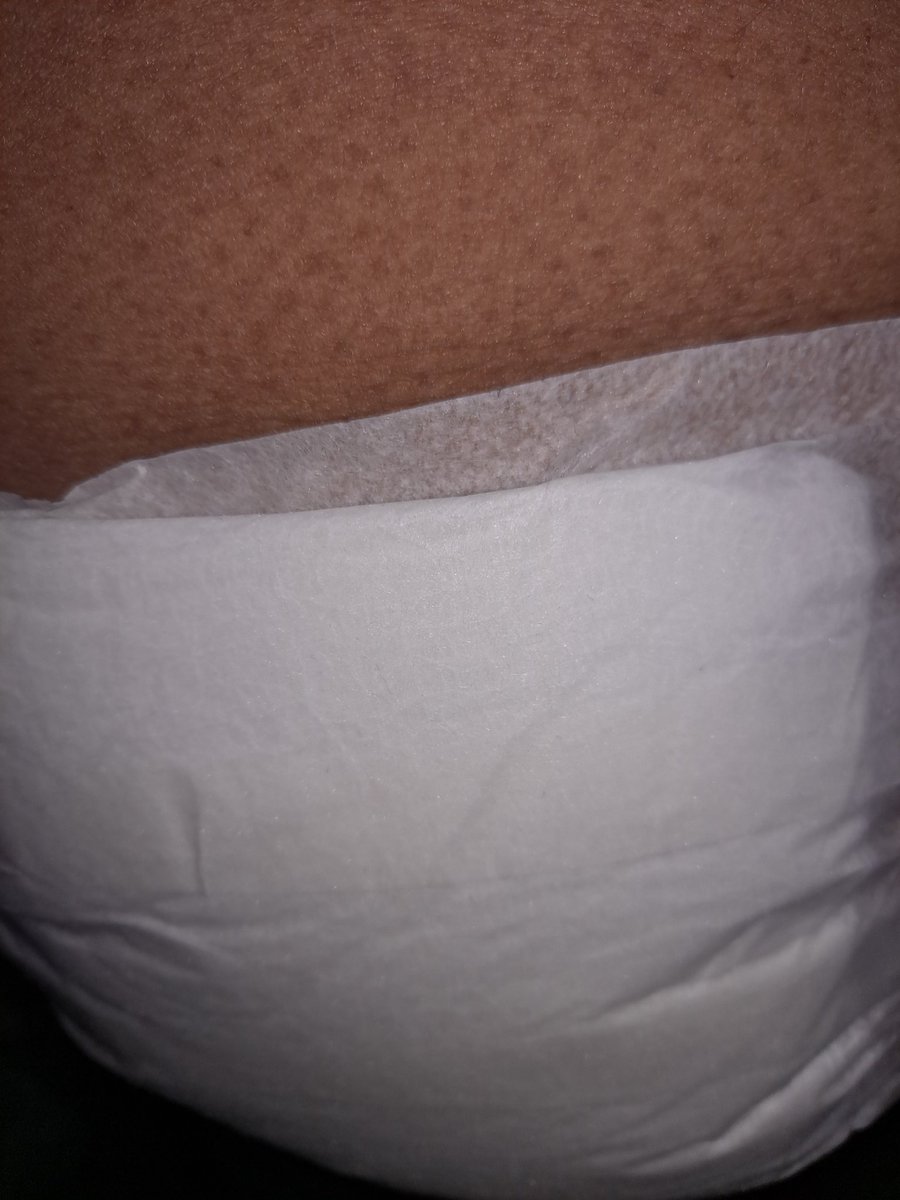 ForkNifeSpoonie's tweet image. Last week was diagnosed with #Dercums they Injected some of my painful areas.
 #durham Carolina Vein clinic