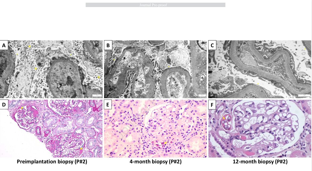 Successful Reuse of Kidney Graft After Early Recurrence of Primary Focal and Segmental Glomerulosclerosis

buff.ly/3xyhY0y

@AghilesHamroun @Ijeb @MaanaouiMehdi @LenainRemi @CHU_Lille @medecine_Ulille #FSGS #kidneytransplant