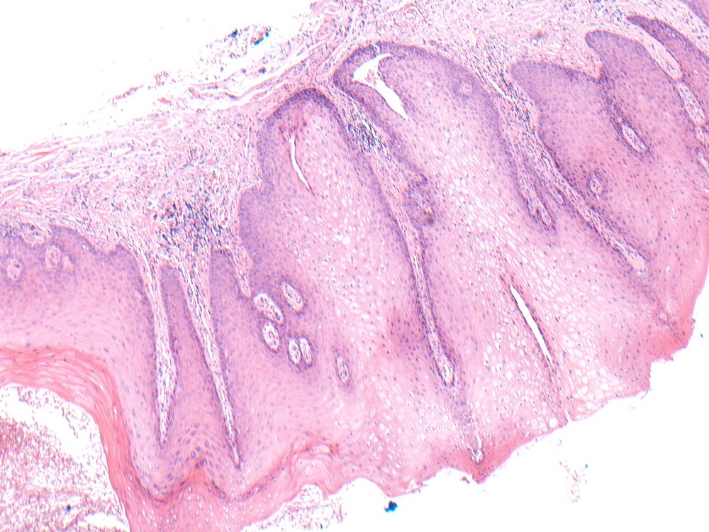 Smokers Palate Histology