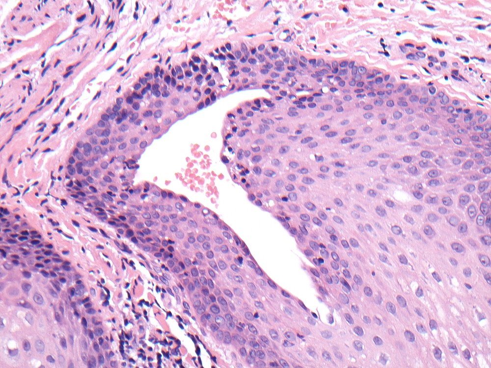 Smokers Palate Histology