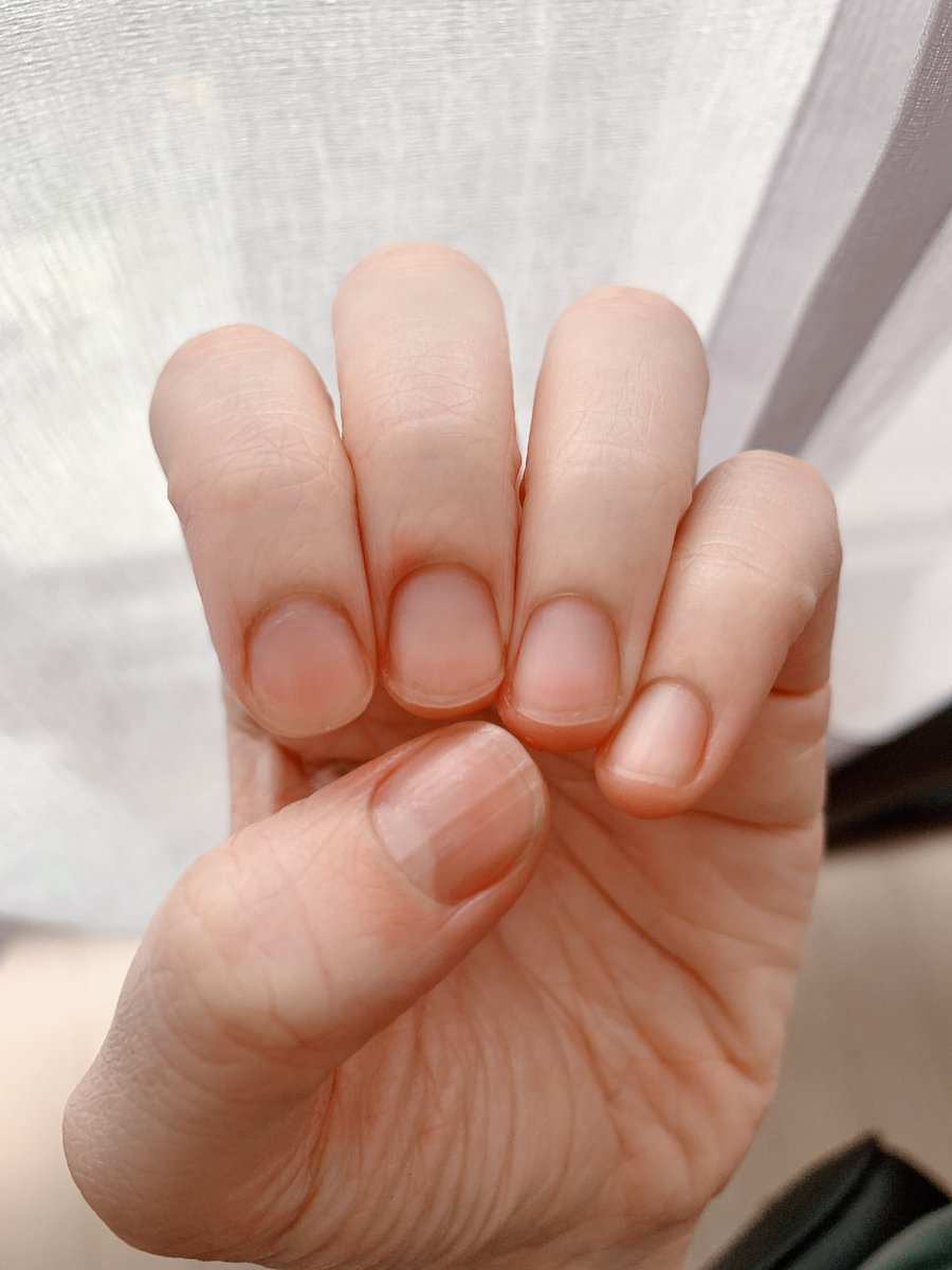 Uni 深爪矯正 育爪 Uni Ix ট ইট র