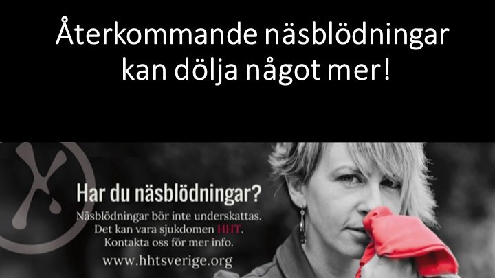 HhtSverige's tweet photo. Idag är det #WorldHHTDay. Om du eller någon du älskar lider av oförklarliga återkommande näsblödningar, kan det finnas en underliggande orsak till blödningen, och det kan vara #HHT #RareDiseases #Vascern #Osler #June23 @sallsynt @eurordis #30millionreasons #EnHalvMiljonSkäl https://t.co/Z0KFMVgOGy