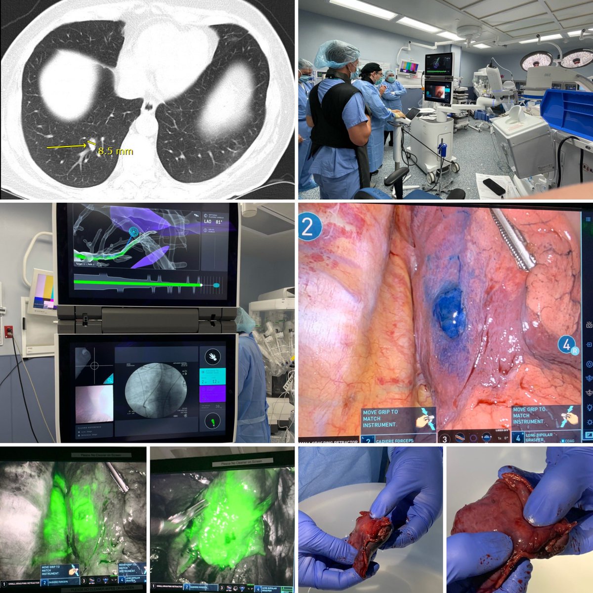 Two for one! Single anesthetic procedure, using Ion robotic navigational bronchoscopy for dye marking of a lone pulmonary metastasis with ICG and methylene blue, to facilitate sublobar metastasectomy with da Vinci robotic surgery. Another great case with <a href="/pulmo_dok/">Napoleon Puente</a> and Dr Stasik.