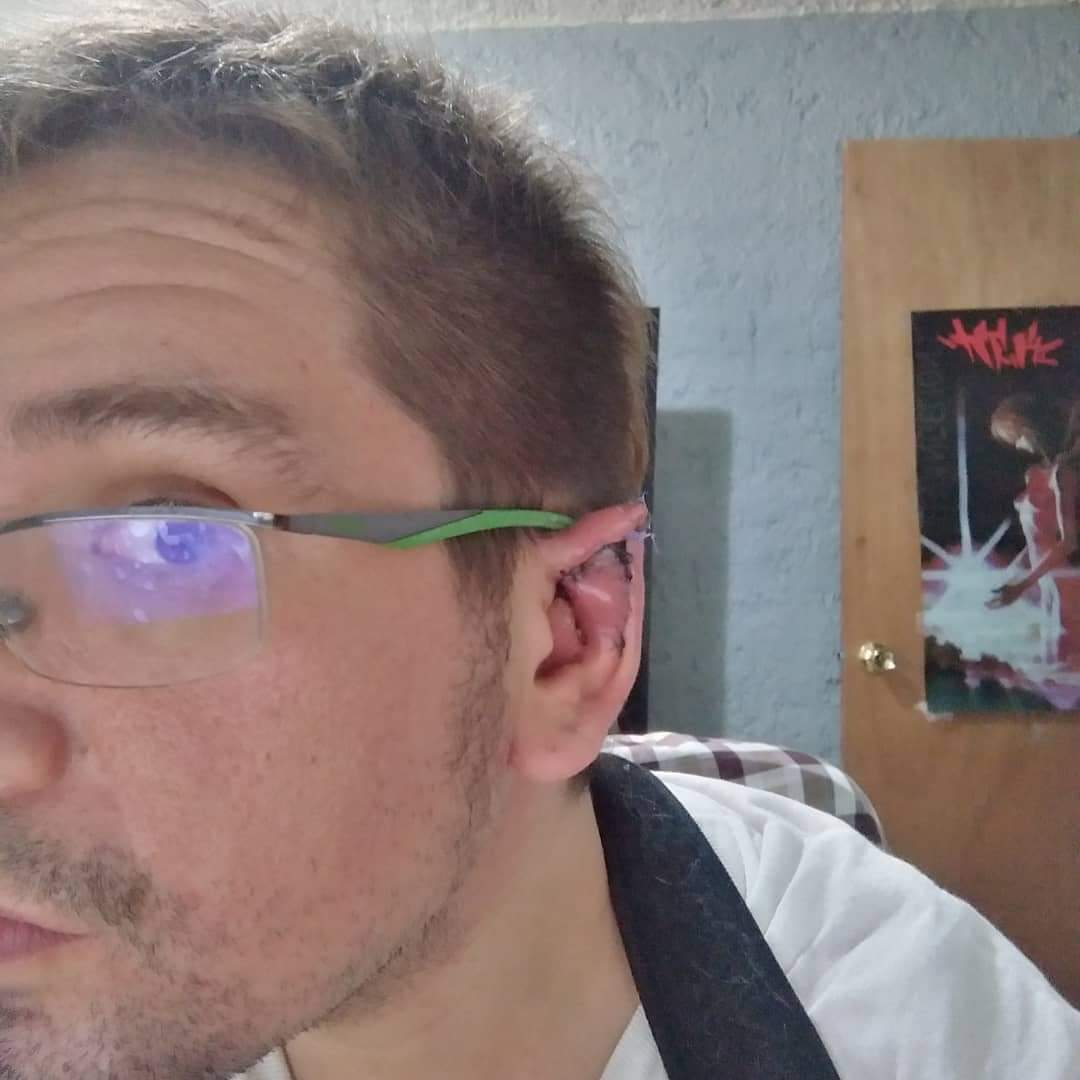 LGrinderwald's tweet image. Hace un año que empecé mi cercenacion de orejas, ahora estoy más feo para no gustarle a nadie #earpointing