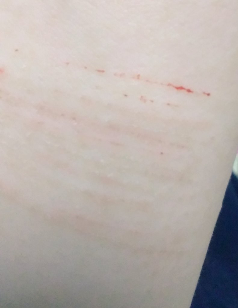 リスカ痕 Twitter Search