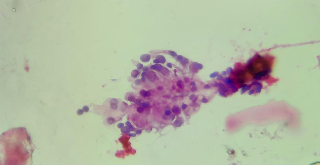 cherradi07's tweet photo. Thyroid cytology https://t.co/OXcK3oDJWB