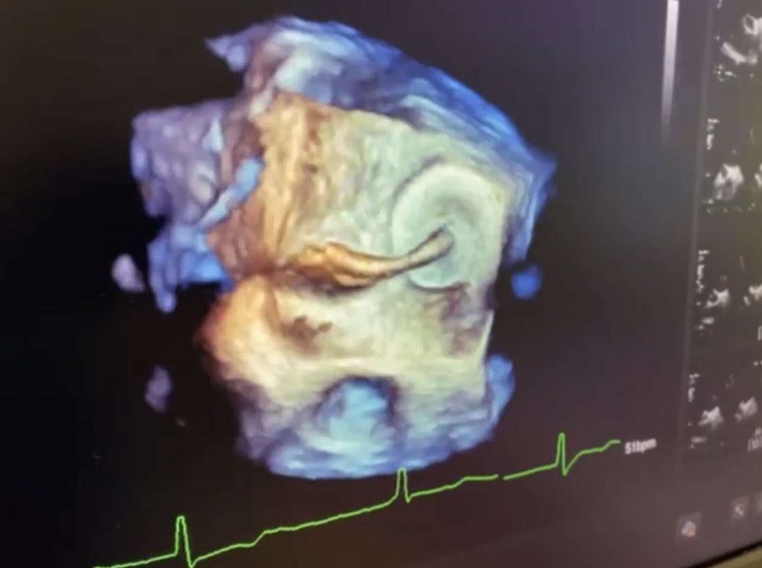 Ingo Eitel (@ingoeitel) on Twitter photo #First clinic in North Germany using the new #amplatzer steerable delivery sheath from <a href="/AbbottNews/">Abbott</a> for #LAAC #Amulet implantation with great result #LAAO #afib #stroke <a href="/t_stiermaier/">Thomas Stiermaier</a> <a href="/GFurnau/">Georg Fürnau</a> <a href="/thiele_holger/">Holger Thiele</a> @CardioSchmidt <a href="/DGK_org/">Deutsche Gesellschaft für Kardiologie</a> <a href="/AGIKinterv/">AGIK</a> <a href="/RolandTilz/">Roland Tilz</a> <a href="/dirkwestermann/">Dirk Westermann</a> #First clinic in North Germany using the new #amplatzer steerable delivery sheath from <a href="/AbbottNews/">Abbott</a> for #LAAC #Amulet implantation with great result #LAAO #afib #stroke <a href="/t_stiermaier/">Thomas Stiermaier</a> <a href="/GFurnau/">Georg Fürnau</a> <a href="/thiele_holger/">Holger Thiele</a> @CardioSchmidt <a href="/DGK_org/">Deutsche Gesellschaft für Kardiologie</a> <a href="/AGIKinterv/">AGIK</a> <a href="/RolandTilz/">Roland Tilz</a> <a href="/dirkwestermann/">Dirk Westermann</a>