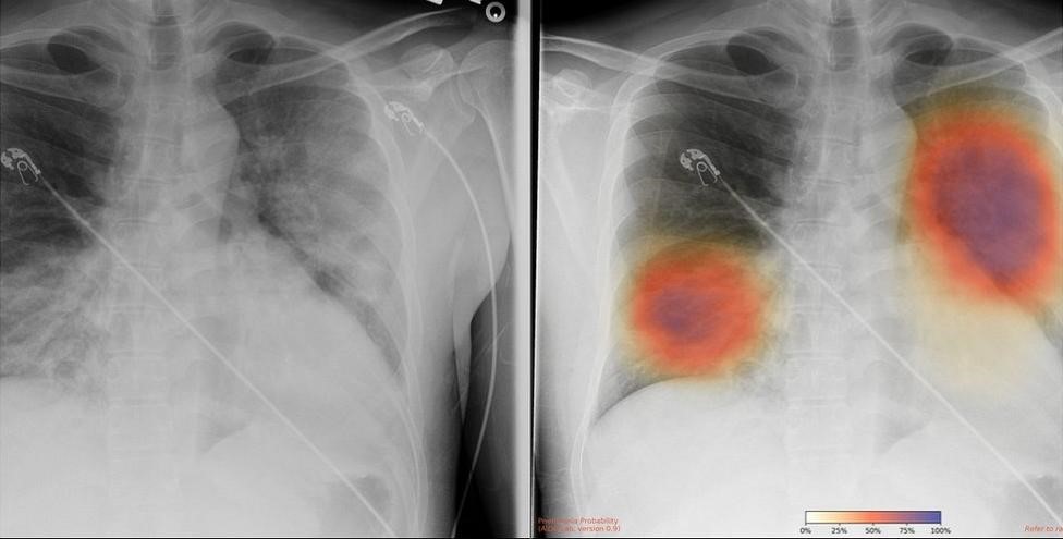 DoctorRHK's tweet photo. The NYU Grossman School of Medicine uses AI tools of radiology to check for COVID complications that can arise within four days. The results are 80% accurate. Check here: https://t.co/DmPBzEb5sK
#chestxray #radiology #AItools #AIinmedicine #covid19 #stopcovid #healthcare https://t.co/6xFeyXlnJw