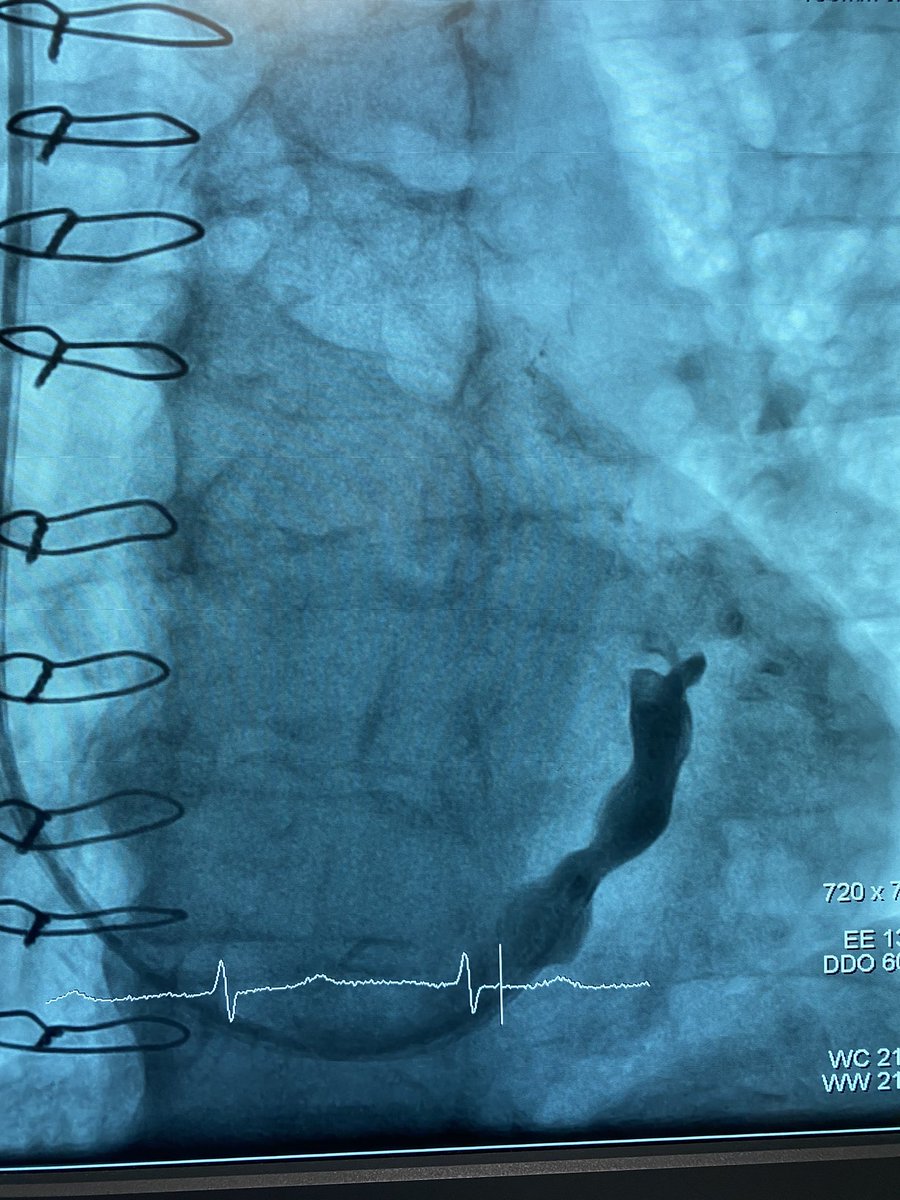ZSharalayaMD's tweet photo. Very excited to have done 4 coronary sinus reducer devices successfully with expert proctoring from Dr. Shmulik Banai with Dr. Jai Khatri and Dr. Rishi Puri. Looking forward to Cosira 2! @BillRLittle @tavrkapadia @GreggWStone @DrAllenJ @CardioNerds @CleClinicMD @ClevelandClinic https://t.co/Rus82aCs7a