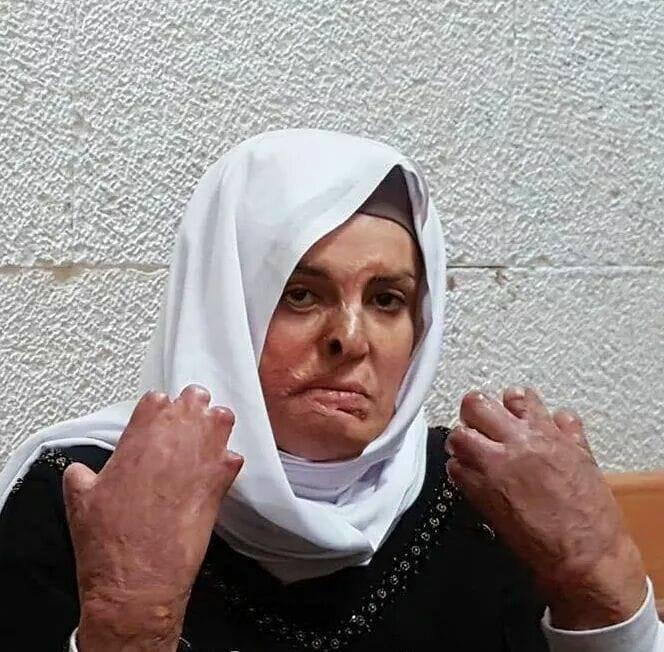 mohaliq's tweet photo. Israa Jaabis is a Palestinian prisoner who was arrested in 2015. Her car was burned on her way home by the occupation that accused her of carrying out a terrorist attack. 60% of her body was burned &amp; she lost 8 fingers bcz no medical care or surgeries were performed!
#SaveIsraa https://t.co/0ZFbMCggZt