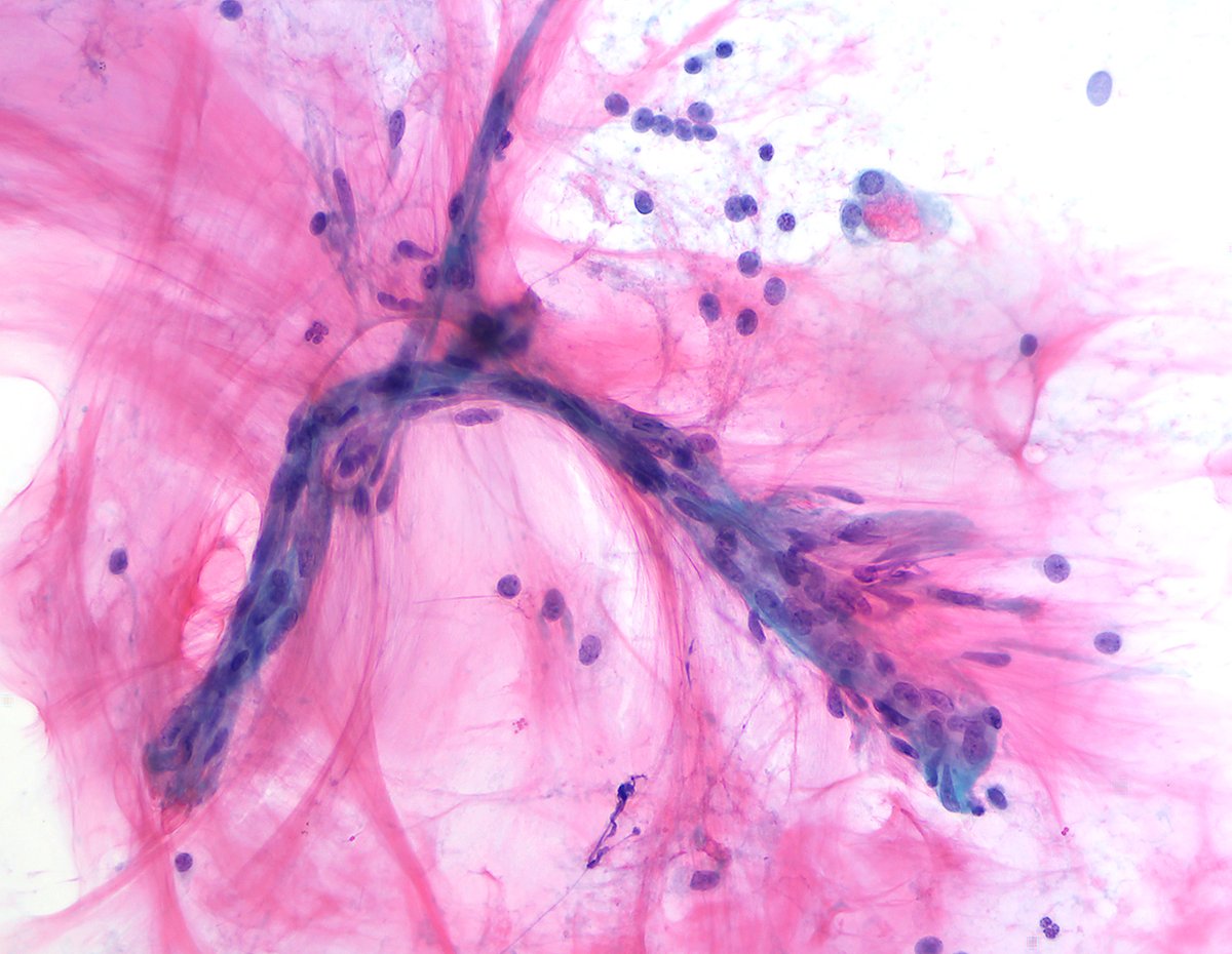 Almost a "Mercedes-Benz" sign - Branching capillaries floating in a pool of colorful mucin from the very RARE, "Mucoepidermoid Carcinoma" of the breast. Cytopathology is truly FASCINATING. I guess we all agree!