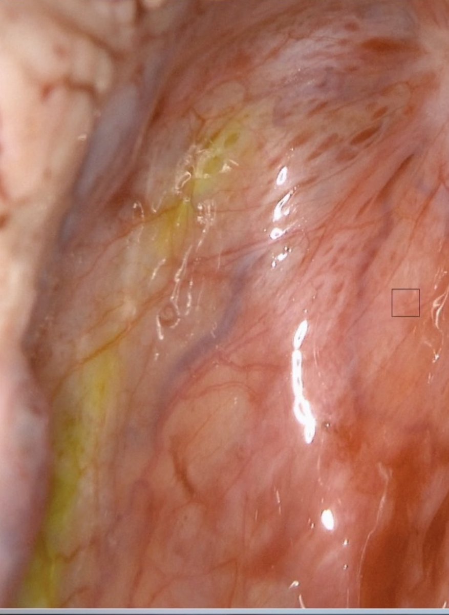 Is this a ureter? YES; Is this ICG? NO……more innovative NIR surgery <a href="/UCLDivofSurgery/">UCL Div of Surgery</a> <a href="/ASampaioSoares/">Antonio S Soares</a> <a href="/MIC_DIANA_IRCAD/">Michele Diana IRCAD</a> <a href="/SWexner/">Steven D Wexner MD, PhD</a> <a href="/AntoniodeLacy/">Antonio de Lacy</a> <a href="/AISChannel/">AIS Channel</a>