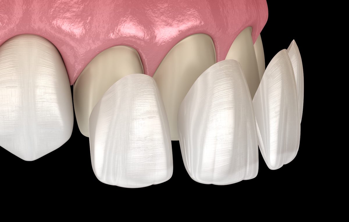 deCardenasDMD's tweet photo. In dentistry, a veneer is a layer of material placed over a tooth. Veneers can improve the aesthetics of a smile and protect the tooth's surface from damage.

Call the office today!
We are here to answer all your questions!! 
☎️ 305-821-2752 ☎️ https://t.co/Kt4E0hraVZ