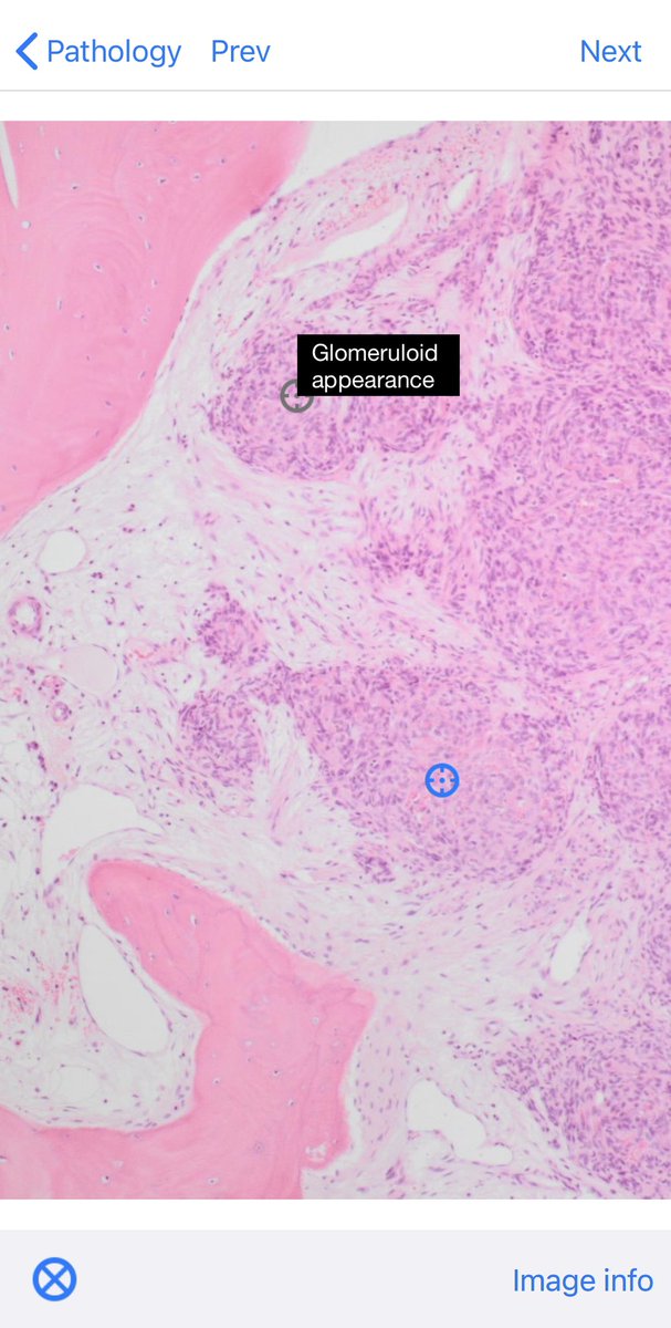 BoSTT_app's tweet photo. Case 108 @BoSTT_app . Bone / soft tissue tumour.
Enjoy the details and learning points in the app. #BSTpath #FOAMed #MSKRad #FOAMrad #pathology #radiology #bonetumor https://t.co/LJYzBdq2zS