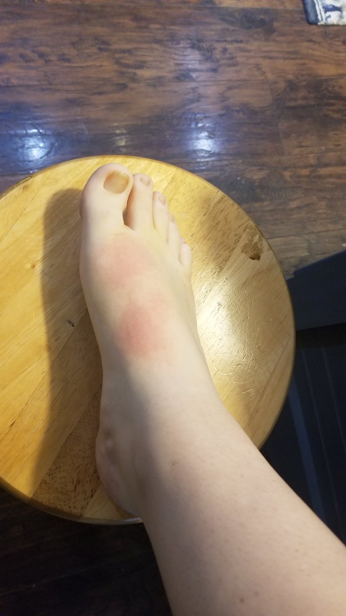 JustAPaige520's tweet photo. I was boiling water to dye something for a friend when the water splashed, burned my foot and stained my new #achievementhunter shirt that I just got in yesterday 😭😭😭 https://t.co/l3kWG1anvO
