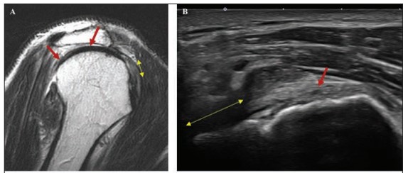 New @AJR_Radiology Accepted Manuscript: 'The Evolving Roles of MRI and Ultrasound in First-Line Imaging of Rotator Cuff Injuries' By Drs Zoga, @sarahkamelmd, & team @JeffersonRads @MaterDublin @leedsmskradiol1 @UBCmedicine ajronline.org/doi/abs/10.221…