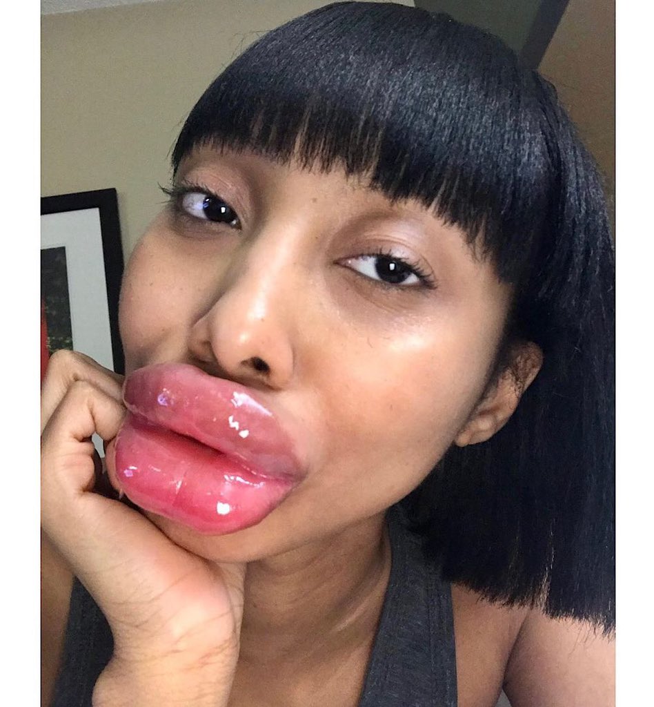 Lipaddictz's tweet photo. @rubydollsunset π€€π€€π€€ ππ #fake #lips #lipinjections #plastic #swollen #lipgap #juvederm #filler #addict #lipfetish #plasticsurgery #plasticpositive https://t.co/KUCIOxX6ap