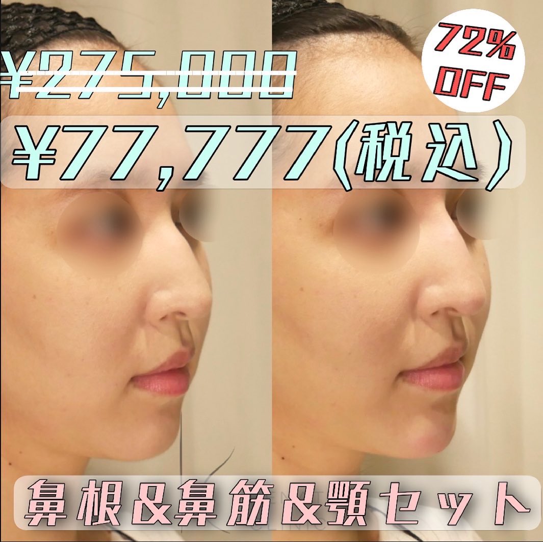 renatusclinic's tweet photo. 破格の72%OFFクレヴィエルキャンペーン‼️なくなり次第終了です‼️
皆様ご予約はお早めに🥰 https://t.co/sImgoDQRn4