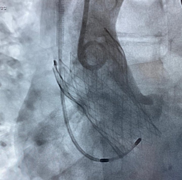 AlkashkariWail's tweet photo. TAVR In low BMI <20 carries higher 1y mort & major procedural complications(access & bleeding،ARF).Using lowest profile devices & being #minimalist is mandatory.Our patient 84y♀️42kg,148cm,BMI 18. #evoluteR 26, RFA, 5Fr radial, 5fr IJ pacemaker, no TEE, 30cc contrast,con sedation https://t.co/ChfCeZ6E8F