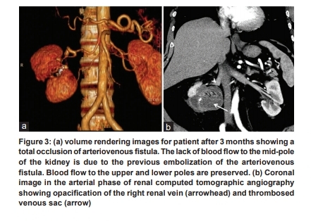 #AJIR Embolization of High Flow Renal Arteriovenous Fistula @althaqufi @Bufatin @pairsmedia @PairsWeb Abstract: thieme-connect.com/products/ejour… HTML: thieme-connect.com/products/ejour… PDF: thieme-connect.com/products/ejour…