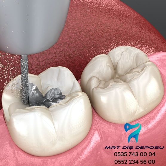 DİŞ SAĞLIĞI İÇİN GEREKLİ BÜTÜN MALZEME VE EKİPMANLAR EN UYGUN FİYATLARLA MRT DİŞ DEPOSU'NDA 0552 234 56 00- 0535 743 00 04  #dişdoktoru #dişhekimi #diş  #gülüştasarımı #dişestetiği #implant #dişbeyazlatma #estetikdiş #dişkliniği  #dişteli  #ağızvedişsağlığı #dişhekimliğifakültesi