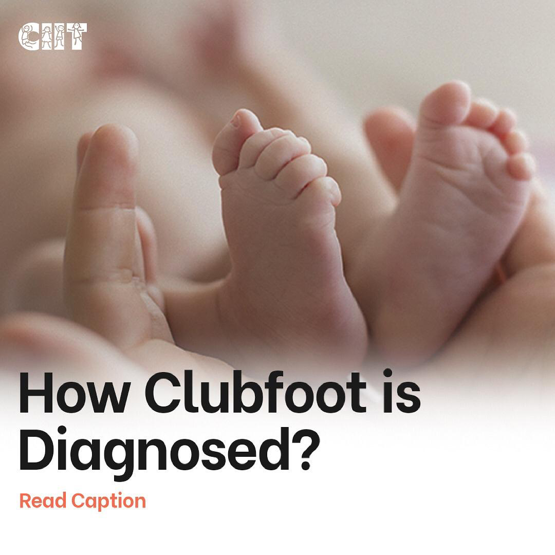 Clubfoot India Clubfoot Can Be Diagnosed During The Ultrasound Either One Or Both Feet Are Twisted Out Of Shape The Important Thing Is How Fast You Start The Treatment Clubfoot