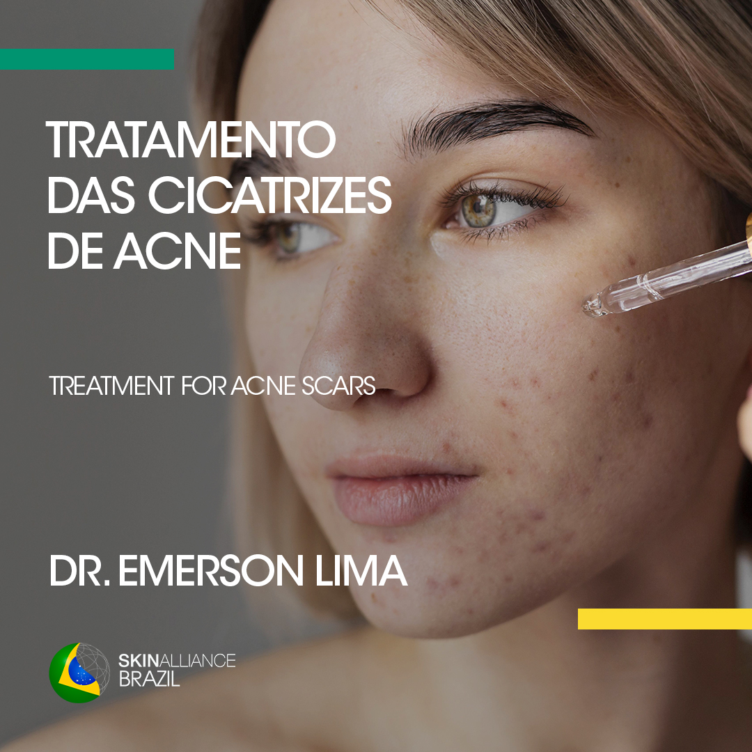 SkinAlliance's tweet photo. 🇧🇷 @SkinAlliance #BrazilianWeek
➡️ Treatment for #acne scars by Dr. Emerson Lima 🇧🇷
👉 https://t.co/0L6BePrdQD
#dermtwitter #dermatologia #skinhealth #dermocosmeticscience https://t.co/ck81zR2Jct