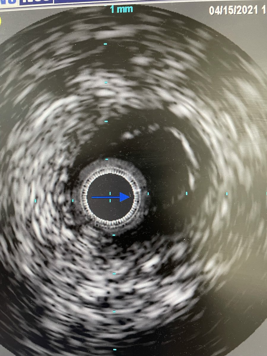 joeygolow's tweet image. Patient with #williamssyndrome with renal artery stenosis #ras #ivus nicely highlights arterial medial hypertrophy at narrowing @MontefioreRAD #irad @socpedsir
