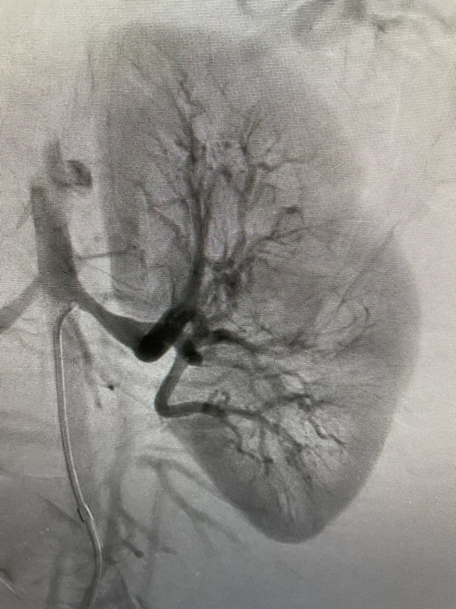 joeygolow's tweet image. Patient with #williamssyndrome with renal artery stenosis #ras #ivus nicely highlights arterial medial hypertrophy at narrowing @MontefioreRAD #irad @socpedsir
