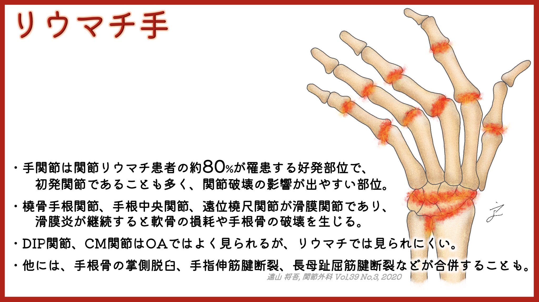 ユジカワ 整形dr イラストレーター 関節リウマチにおいて 手は好発部位になる その中でも 罹患しやすい関節 しにくい関節があるので 覚えておくと診断の一助になる リウマチ イラスト日記 手 T Co Ywrn2jlbyd Twitter