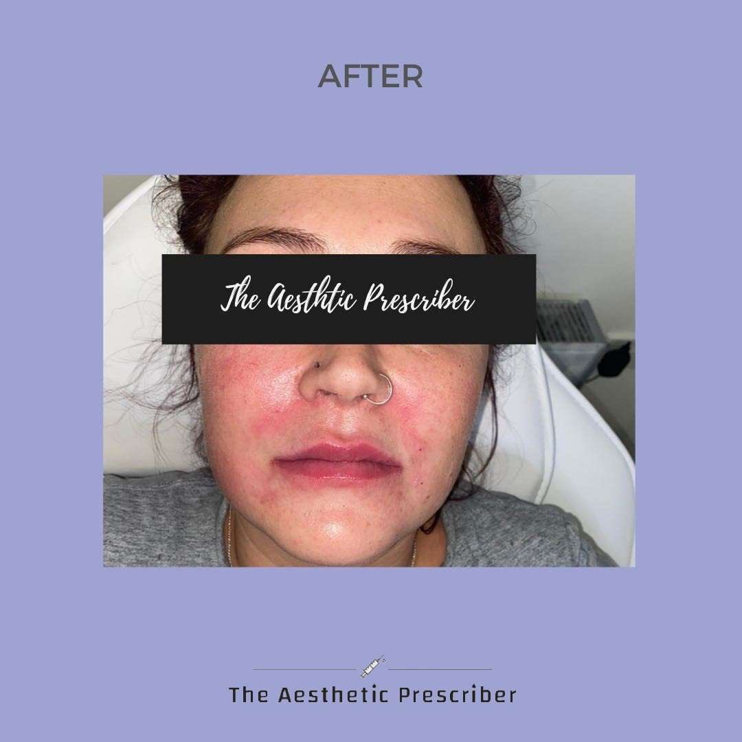aestheticpresc's tweet photo. Ageing causes our natural elastin and collagen from our skin to diminish resulting in loose skin that is prone to wrinkles!! 

Fillers can be used to prevent wrinkles

How?

Fillers contain hyaluronic acid which stimulates the skin’s natural collagen production to lift and plump https://t.co/PbTyeD8rij