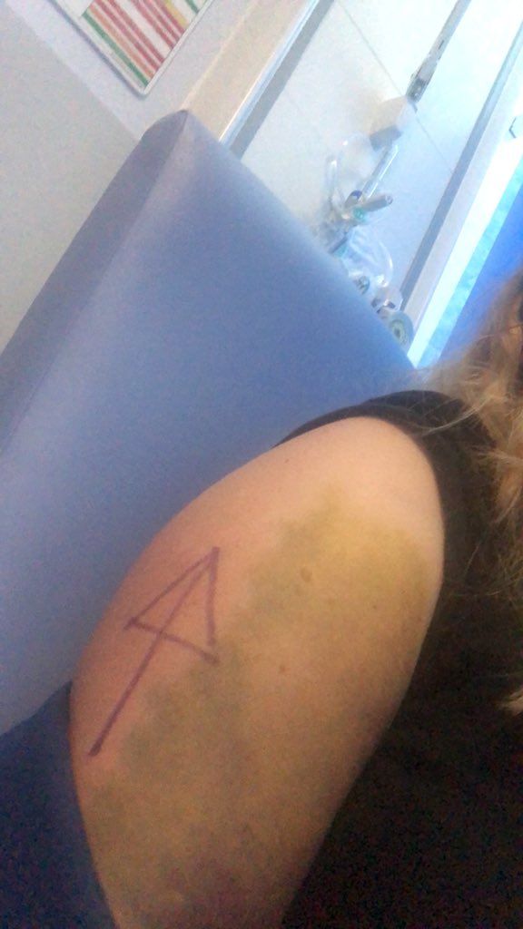 Estephy's tweet photo. @JasonManford I personally thought the arm I needed surgery on was pretty obvious given the enormous bruise that accompanied it. https://t.co/ejyHun8q1C