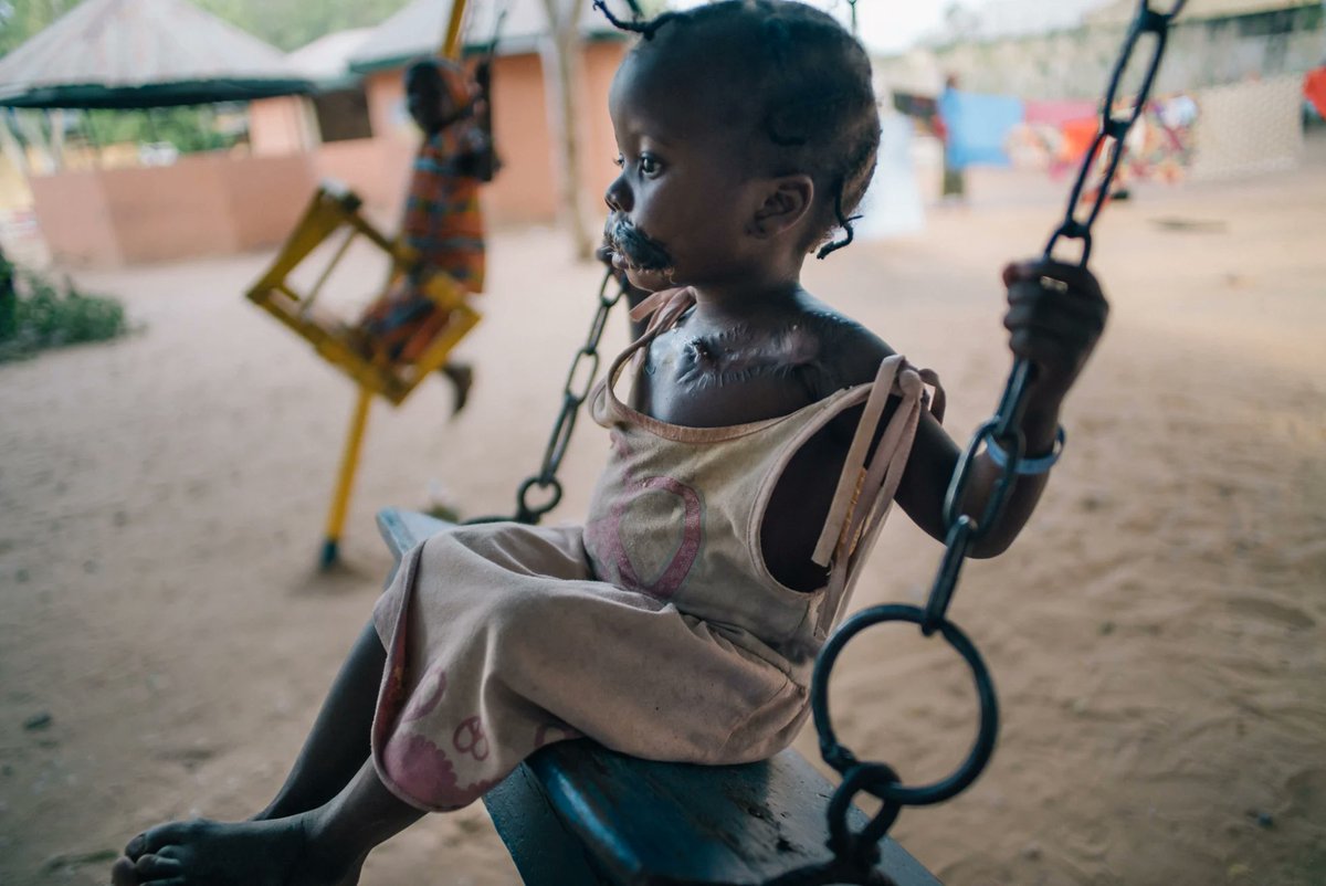 Global Water 2020 (@globalwater2020) on Twitter photo Click π for <a href="/RebeccaLRoot/">Rebecca. L. Root</a>βs new visual story on Noma. Learn about how this deadly and disfiguring disease targets children from 2-6 that lack #WASH and come from extreme poverty, and those who are trying to raise awareness and treat it. <a href="/ISNTD_press/">ISNTD</a> <a href="/MSF/">MSF International</a> bit.ly/2U2YVwV Click π for <a href="/RebeccaLRoot/">Rebecca. L. Root</a>βs new visual story on Noma. Learn about how this deadly and disfiguring disease targets children from 2-6 that lack #WASH and come from extreme poverty, and those who are trying to raise awareness and treat it. <a href="/ISNTD_press/">ISNTD</a> <a href="/MSF/">MSF International</a> bit.ly/2U2YVwV