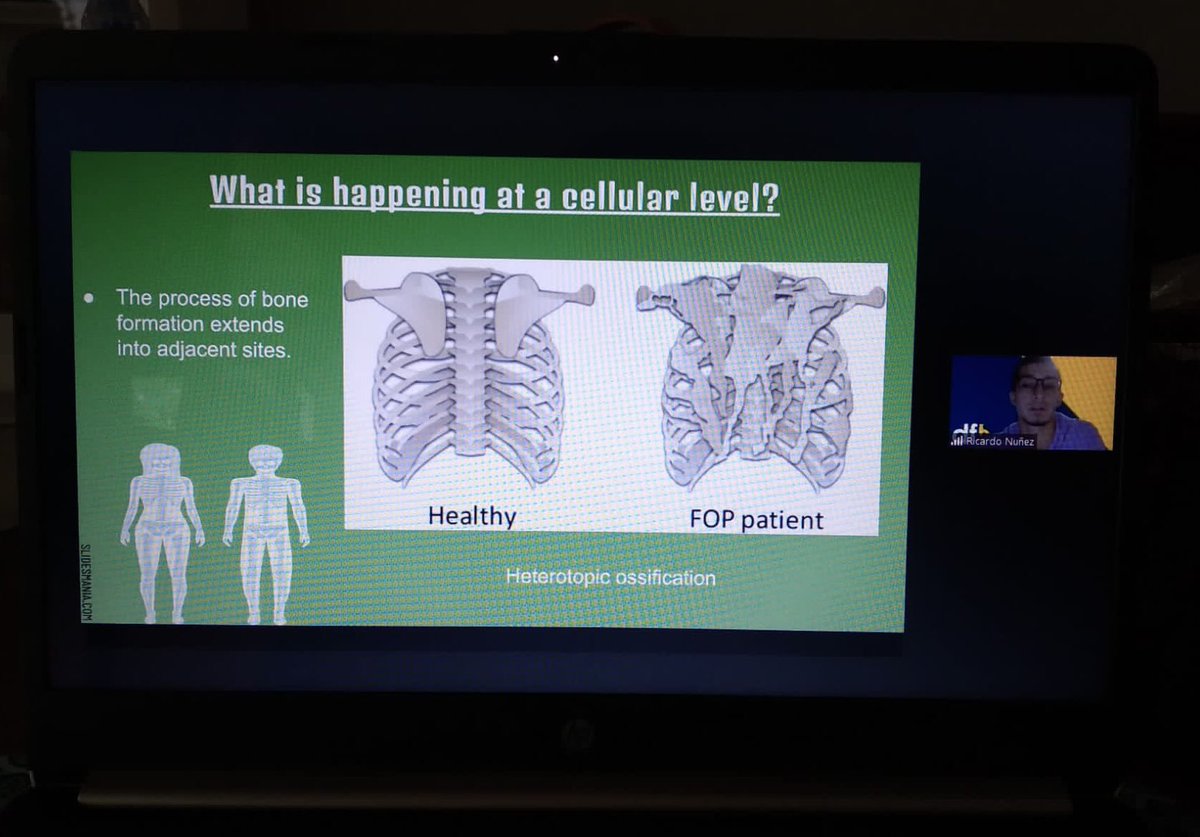 DFB_UM's tweet photo. We got to learn more about Fibrodysplasia Ossificans Progressiva during our student presentations. Great job Team Hippo & Team mTOR! 👏🏼 #DFB2021 https://t.co/HJYBmOlcsh