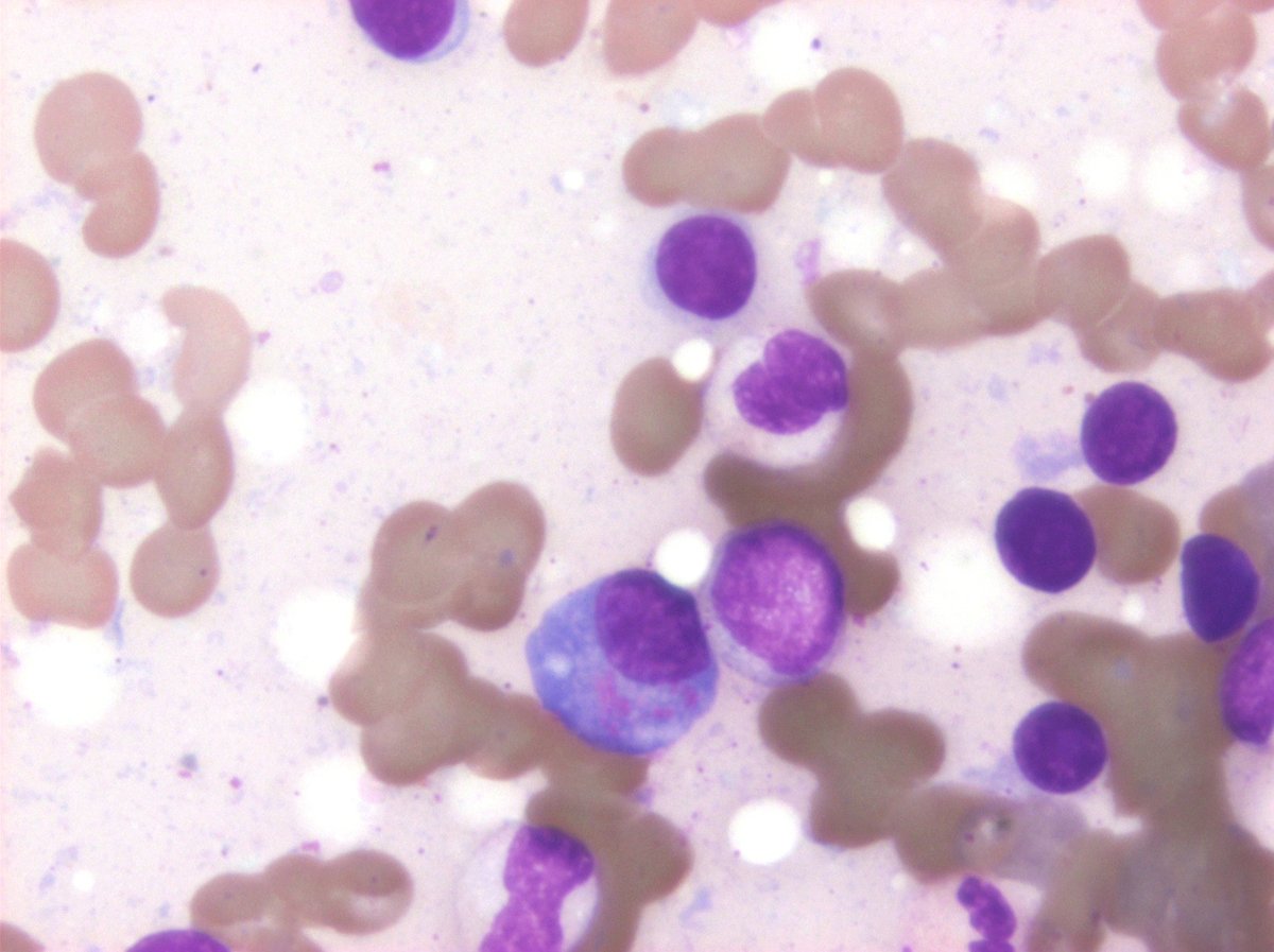 Plasma cell myeloma with cytoplasmic granules