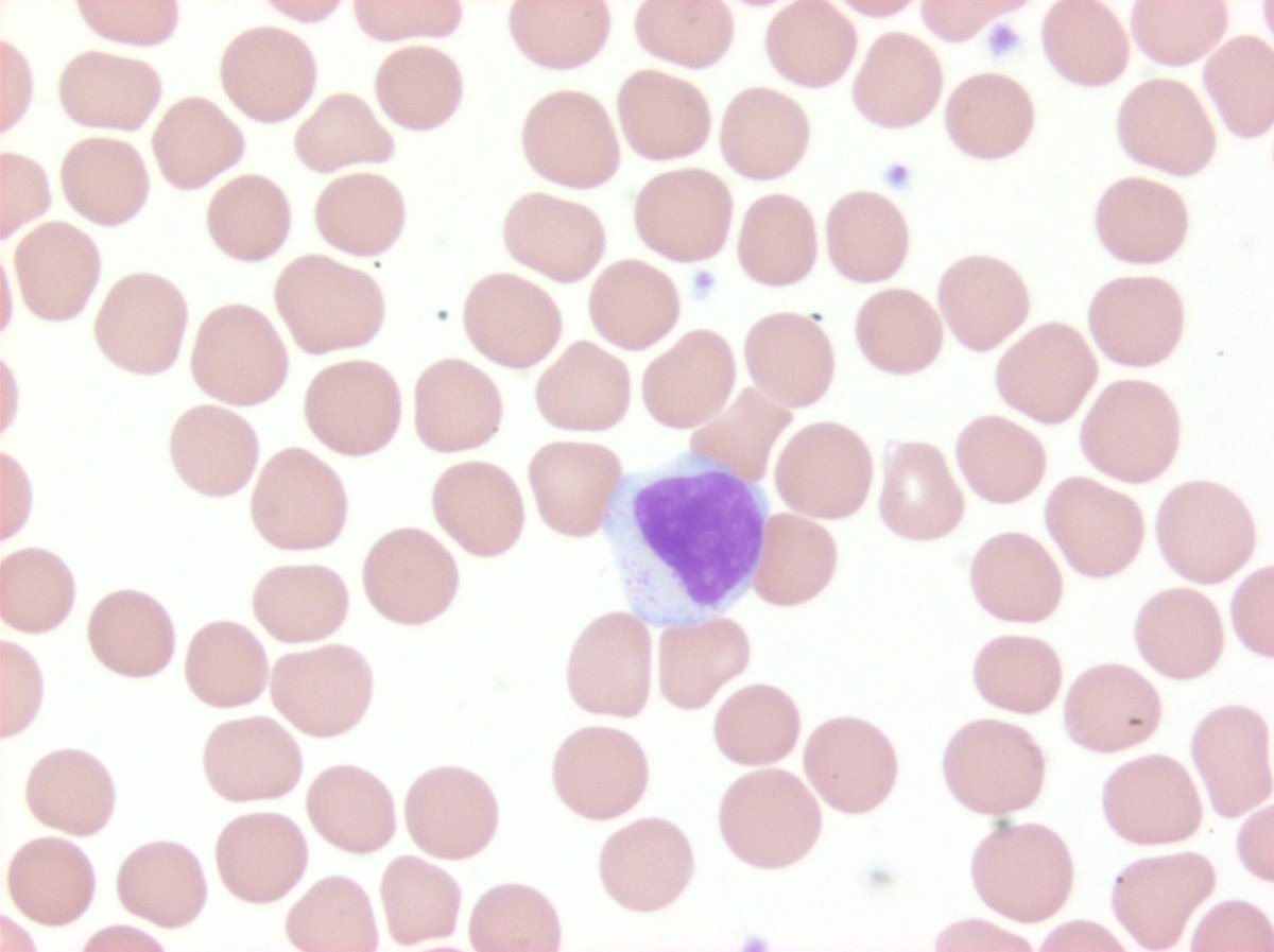 T-LGL, clonal, but not quite high enough counts to make T-LGL leukemia