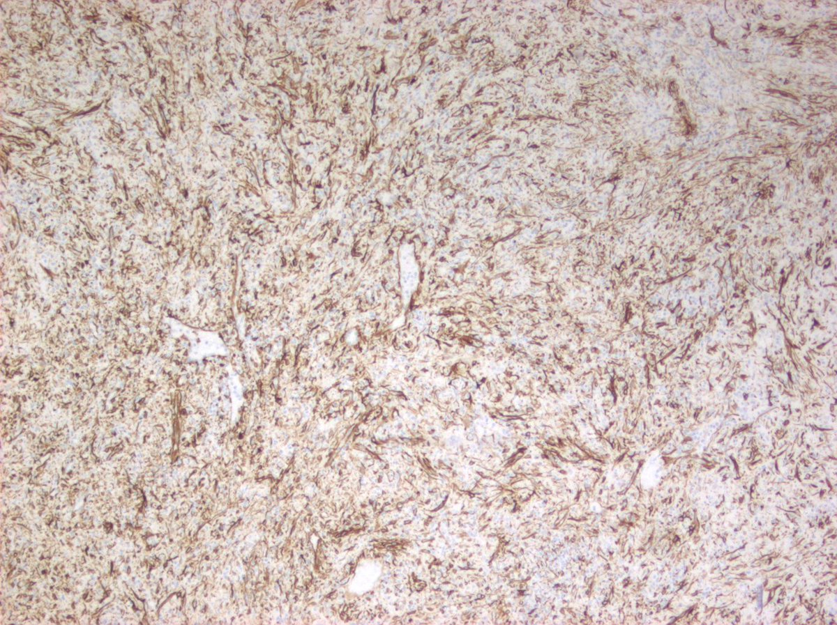 Spleen - sclerosing hemangioma, WT1 stain