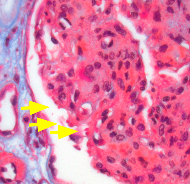 JZRenalPath's tweet photo. Diabetic with acute kidney injury, 16 g proteinuria, hematuria. Nodular diabetic nephropathy, yes, but endocap PMNs, C3 dominant and IgA deposits, hump-like sub epithelial deposits on EM and seen on trichrome. --> Superimposed infection related GN. #renalpath #nephropath https://t.co/2Bq4LzSuIO