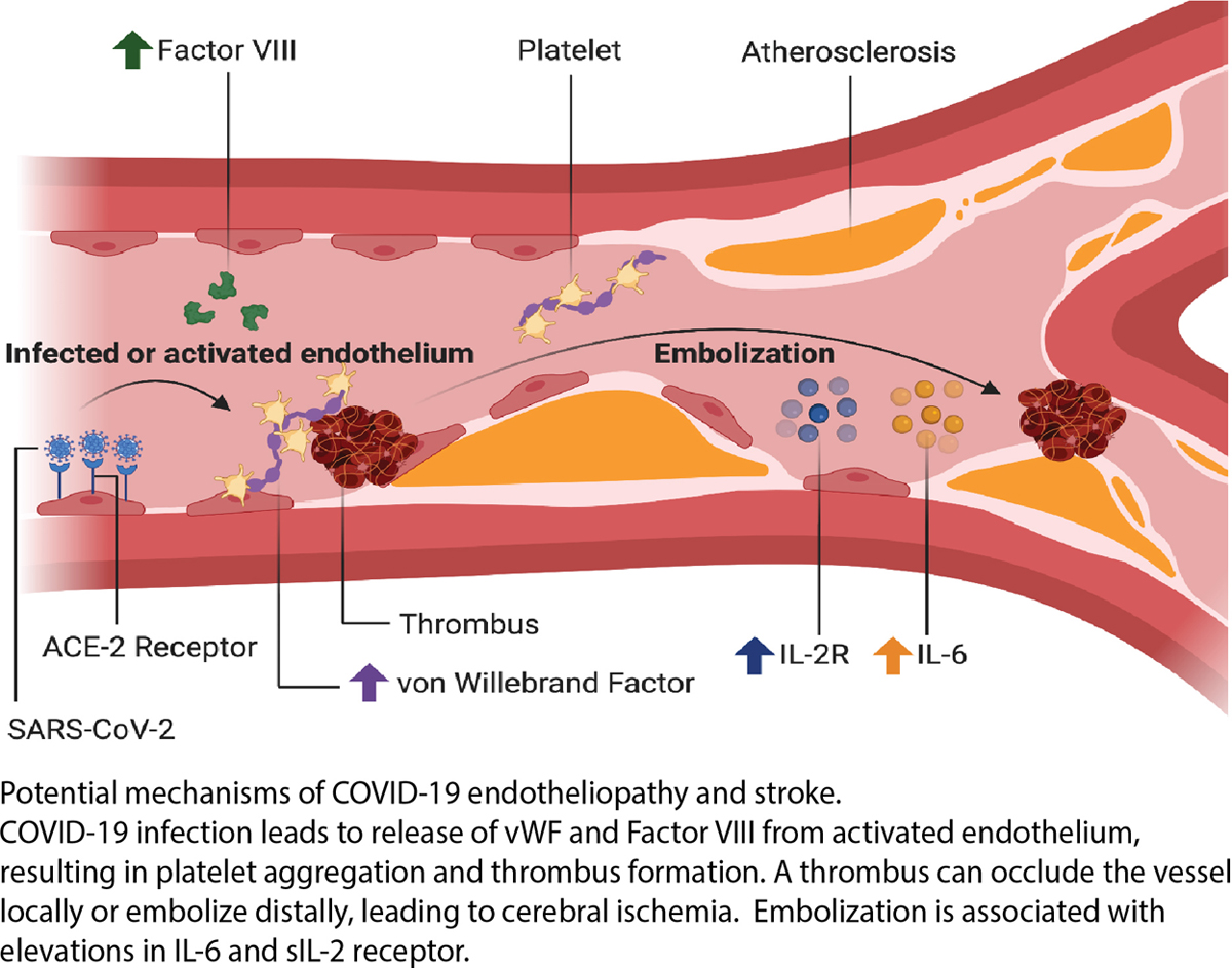Systemic #Inflammation and #Endotheliopathy among ischemic #stroke patients with #COVID19 #AHACOVID19 ow.ly/LoPx50FhO1y @LaurenHSansing @NeurologyYale @SerenaSpudich @kevin_sheth @MatoukCharles @SpudichLabYale @YNeurosurgery @LindsayMcA @RichaSharmaMD @hyungjchun @Pola_MD