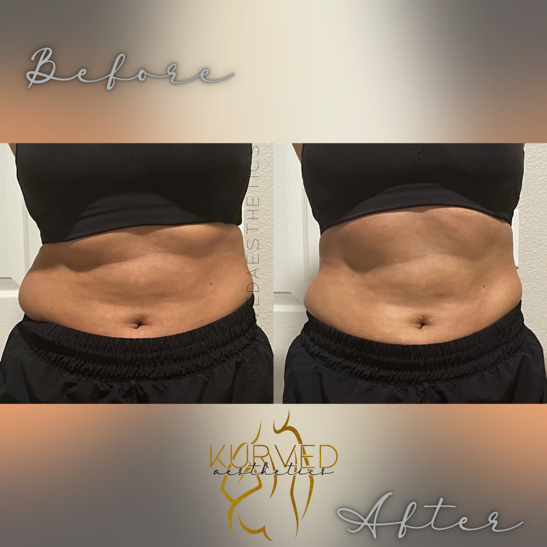 Want a tighter, flatter belly? Dm us! I’m just an hour this is what we can do for you!  Just imagine what can happen in 4 sessions 😍😍😍

#laserlipo #cavitation #rftherapy #woodtherapy #mesotherapy #vacuumtherapy #whatwaist #houstonwomen #houston #tx #webster #laporte #s