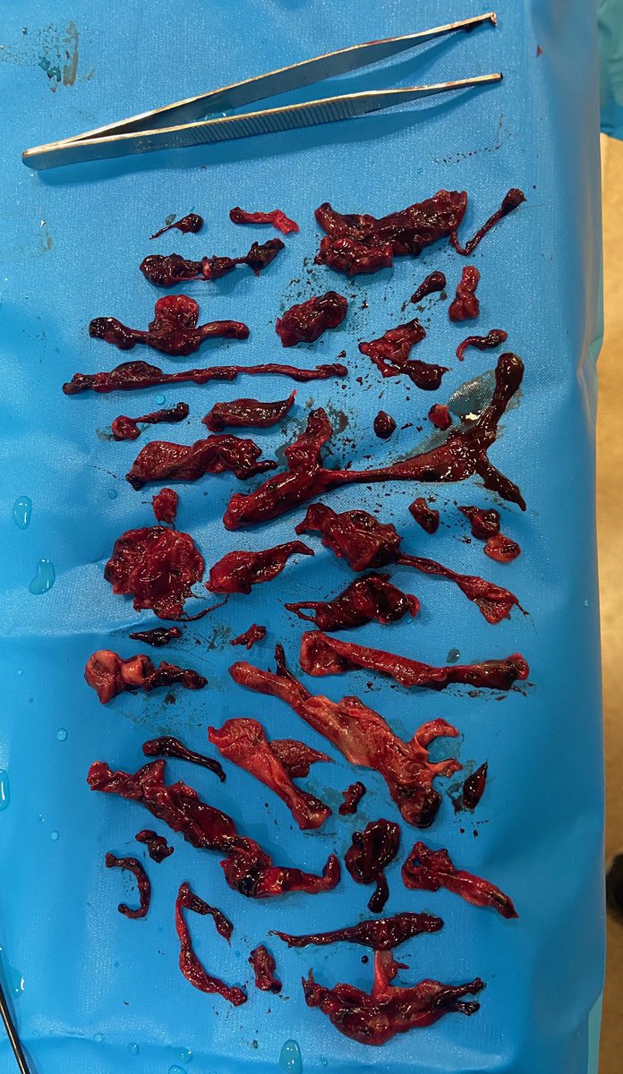 Bir Covid hastasının akciğerinden çıkarılan pıhtılar. Ben normal bir gripten sonra akciğere pıhtı atan bir tane bile hasta görmedim. Ama Covid’de sıklıkla karşılaşıyoruz.

Pıhtılaşma(!) yüzünden aşı olmayanların kendilerini maruz bıraktıkları risk işte bu kadar büyük.