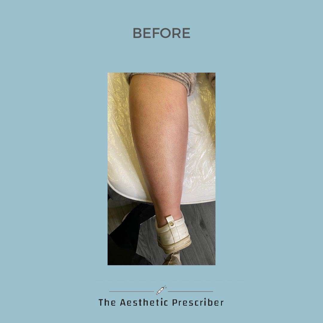 aestheticpresc's tweet photo. Will fat dissolving help me to drop dress sizes?👗

Unfortunately fat dissolving is not a weight loss alternative, your change may be physical but you may not notice a change on the scales. ⚖️

For optimal results one should drink 2L water, exercise and consider a low fat diet https://t.co/AmigWgoU9w