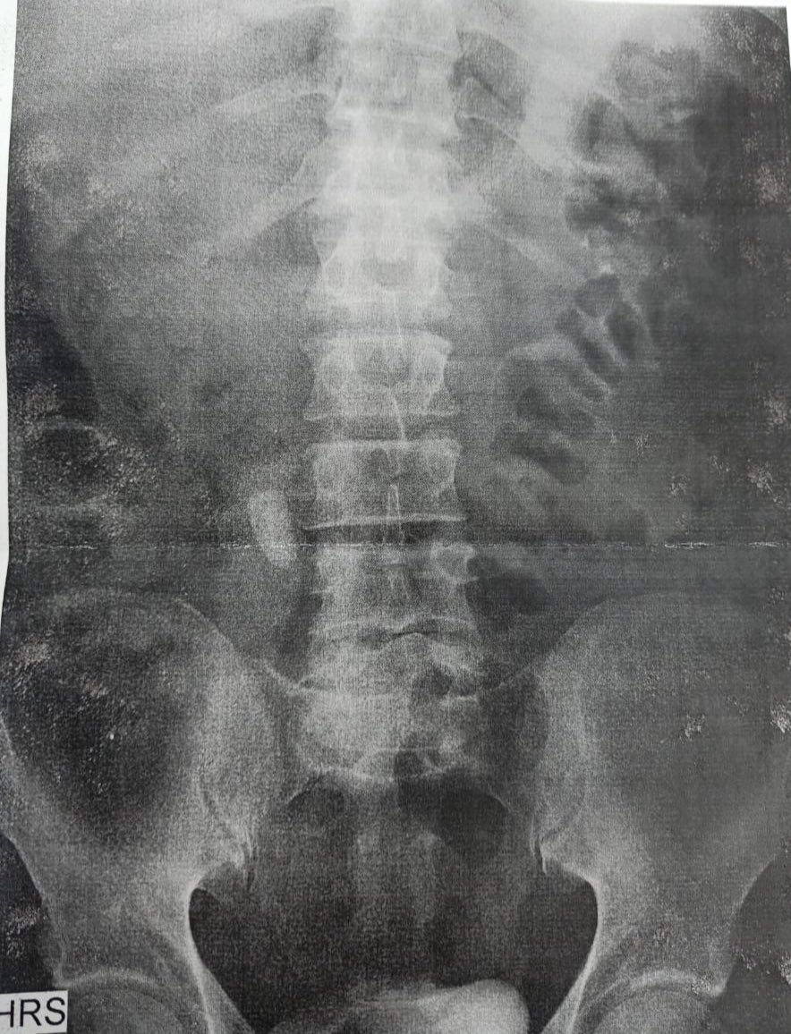 ♾ Same Discussion 👨‍⚕️
🔜 CT Scan 
<a href="/PETRAurogroup/">PETRA</a> <a href="/PEARLSendouro/">PEARLS</a>