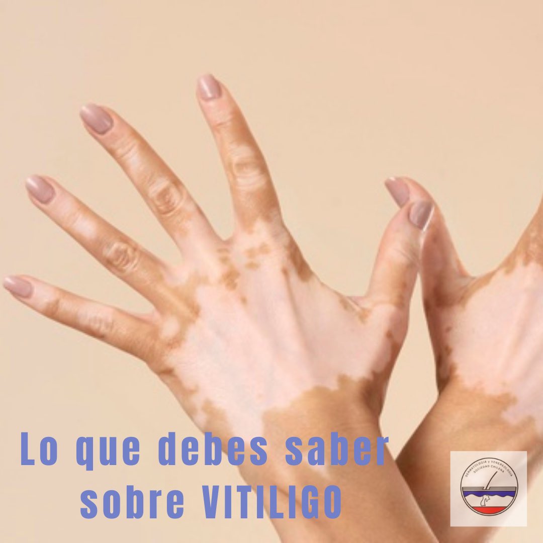 Sochidermv's tweet photo. (1) Hoy es el día mundial del Vitiligo, una enfermedad que padecen más de 100 millones en el mundo.
📌Desde Sochiderm te invitamos a conocer más sobre esta enfermedad y a compartir la información con tus cercanos y amigos.

#vitiligo #vitiligoworldday #awarenessvitiligomonth https://t.co/W189u1KoXK